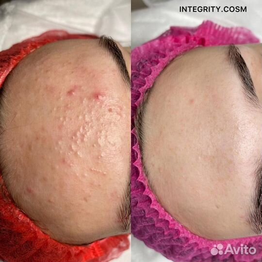 Чистка лица, спины механическая, комбинированная