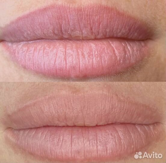 Лазерное удаление татуажа и тату, и ремувером