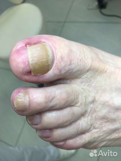 Медицинский педикюр подолог