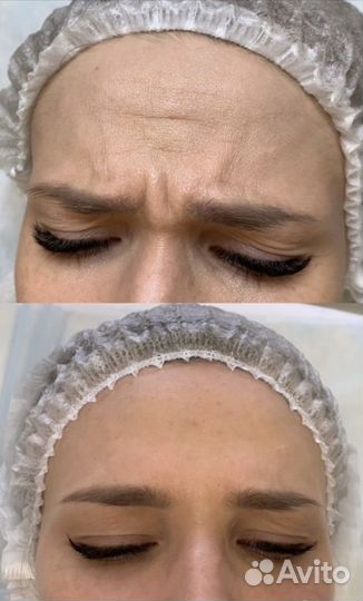 Ботокс (Бутулинотерапия) botox