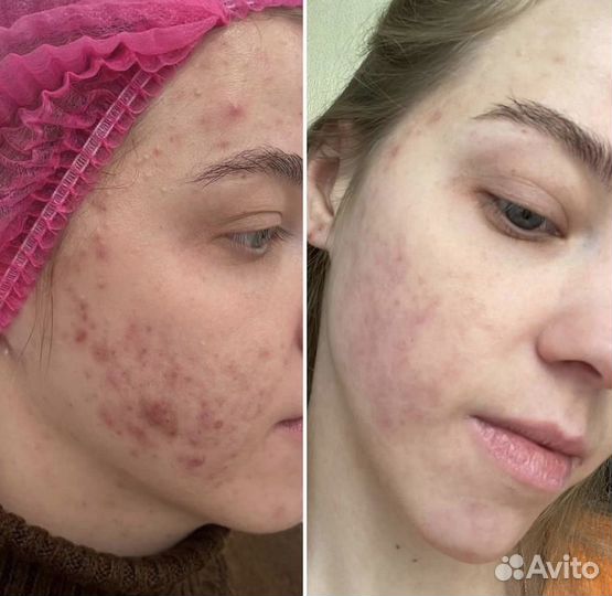 Фототерапия на аппарате М22