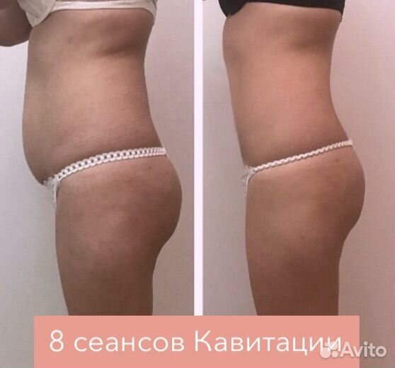 LPG массаж Кавитация Rf-лифтинг