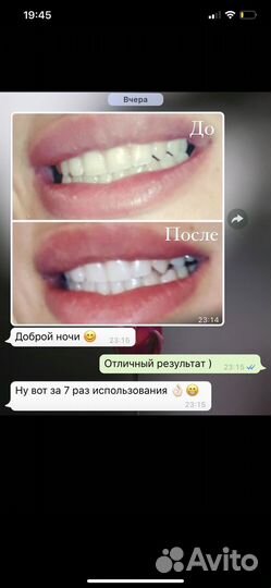 Набор для отбеливания зубов Ivismile