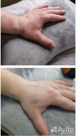 Удаление тату, удаление татуажа