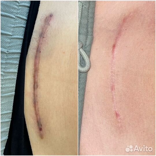 Лазерная шлифовка с охлаждением