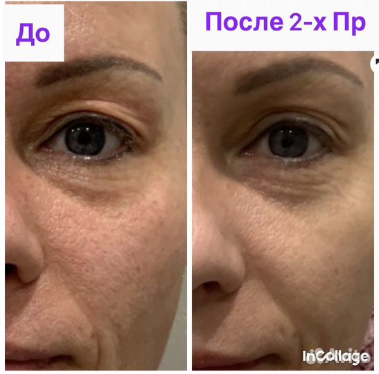 Омоложение Холодной/ Плазмой