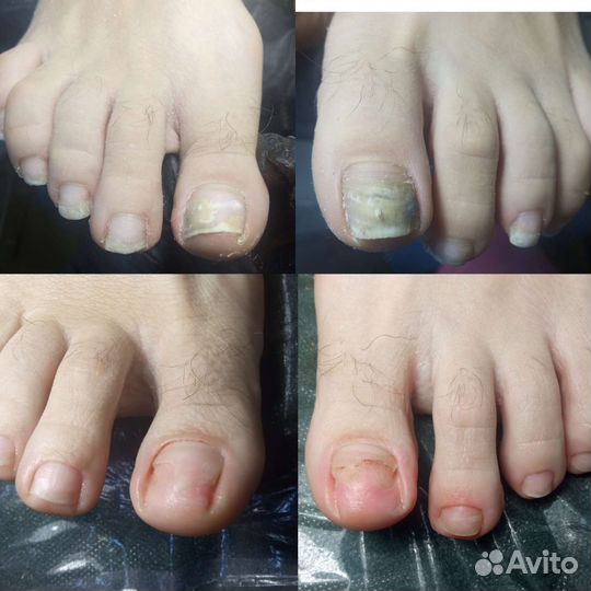 Титановая нить, Коррекционный педикюр