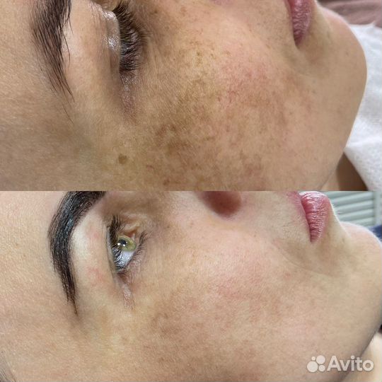 Чистки/пилинги,микротоки,шугаринг,электроэпиляция