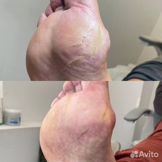 Педикюр подолог