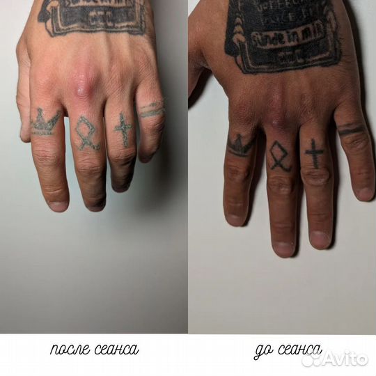 Лазерное удаление тату