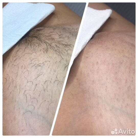 Шугаринг/воск