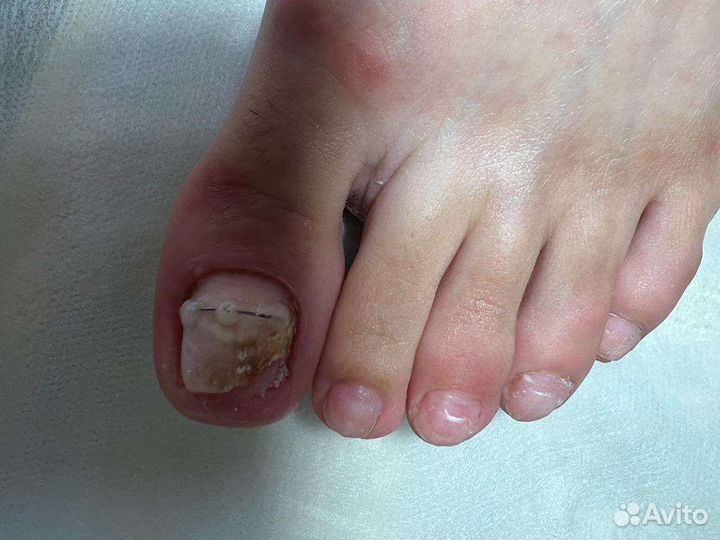 Лечение вросшего ногтя. Медицинский педикюр