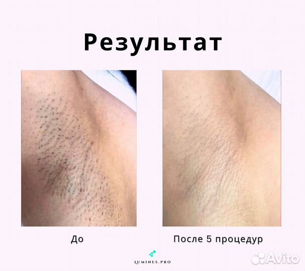 Диодный лазер люминес Макс’Ван 1200 Вт