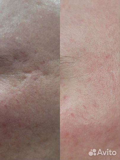 Модели на шлифовку удаление шрамов омоложение