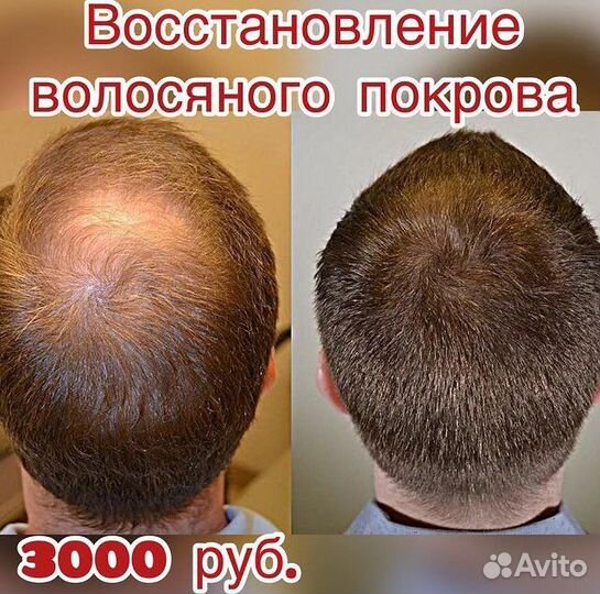 Холодная плазма (омоложение)