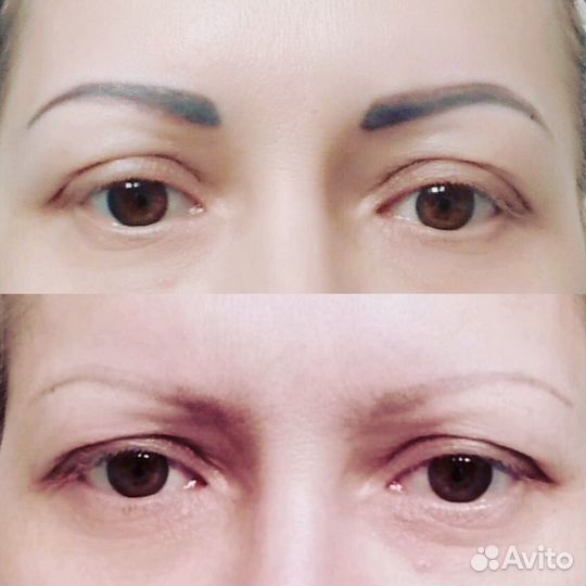 Удаление татуаж,тату и пигментных пятен