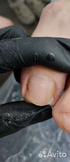 Обработка вросших ногтей и онихолизиса