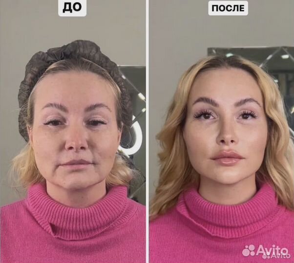 Подтяжка кожи за 1 процедуру. СМАС лифтинг. Омолож