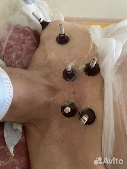 Моксатерапия