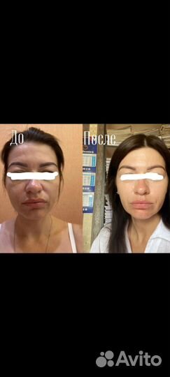 Аппаратная косметология