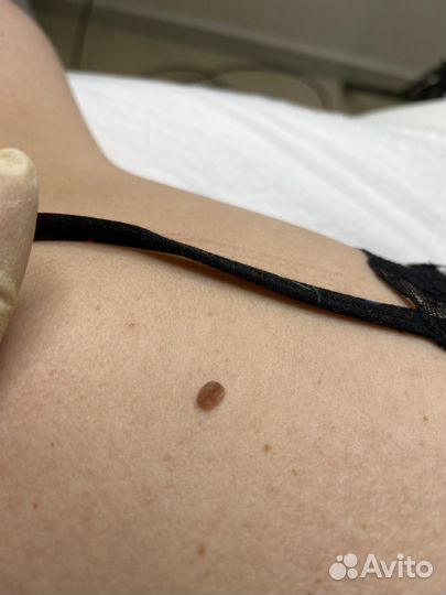 Удаление папилломы