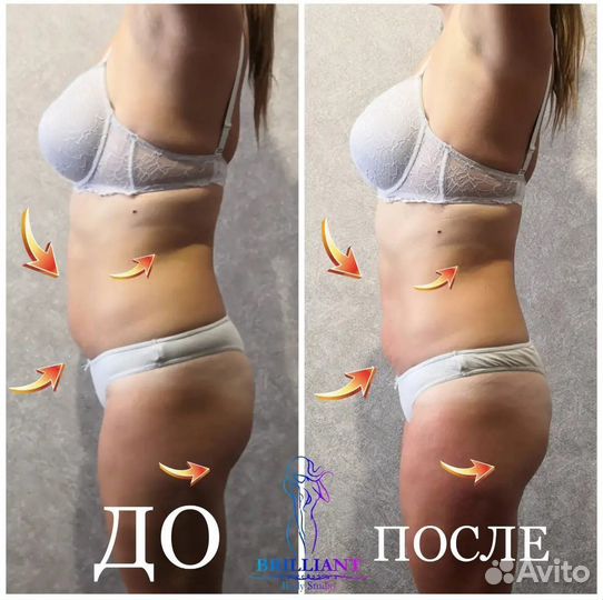 Вакуумный массаж, Кавитация, RF лифтинг