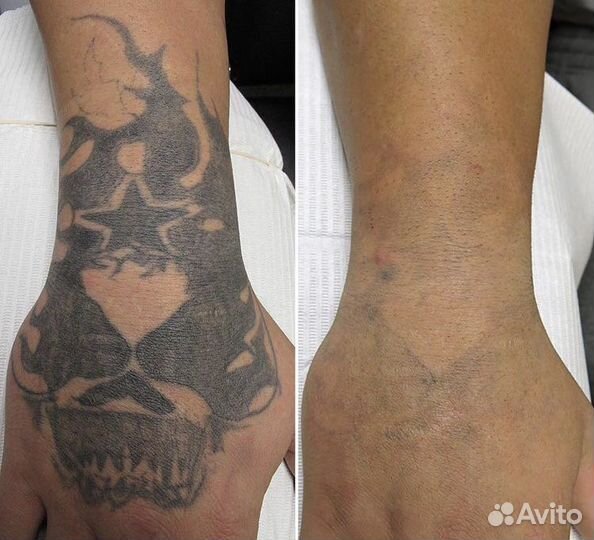 Лазерное удаление тату