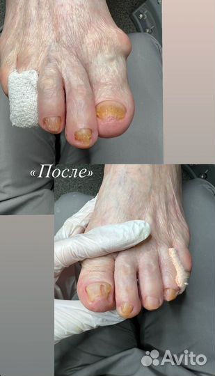 Педикюр подолог