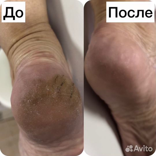 Обработка стоп и ногтей у Вас дома