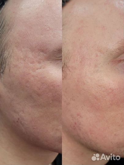 Модели на шлифовку удаление шрамов омоложение