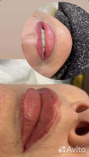 Контурная пластика губ