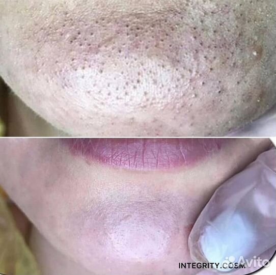 Чистка лица, спины механическая, комбинированная