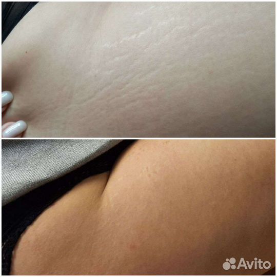 Омоложение холодной плазмой