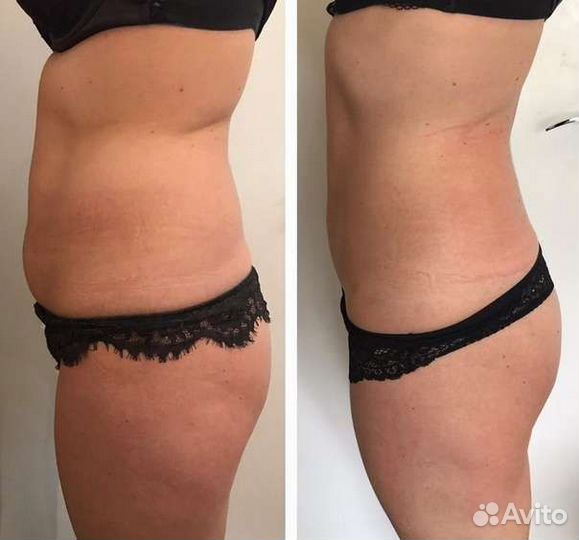 Липолитики похудение,уменьшение обьёмов