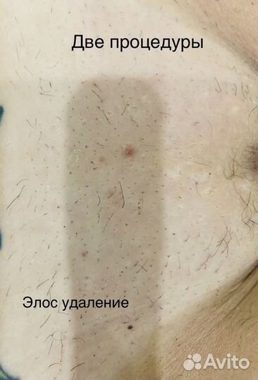 Лазерная Элос Эпиляция