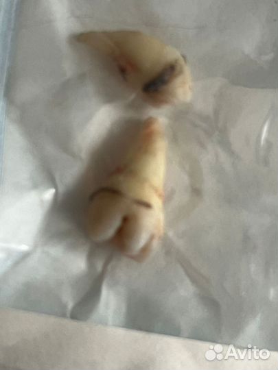 Зуб мудрости