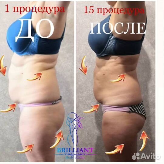 Вакуумный массаж, Кавитация, RF лифтинг