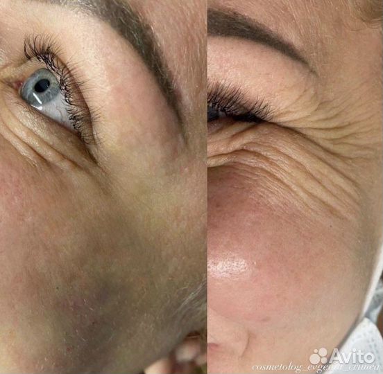 Ботокс для лица