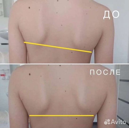 Костоправ Без Боли