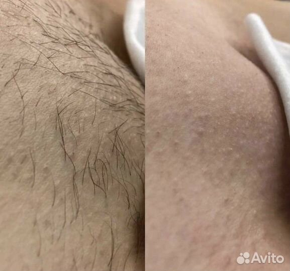 Шугаринг нужны модели для отработки скорости