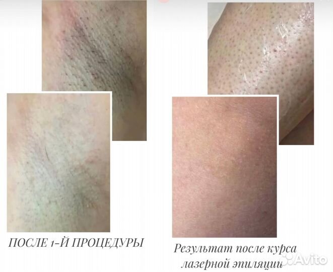 Лазерная эпиляция