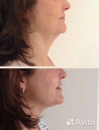 Криолиполиз подбородка
