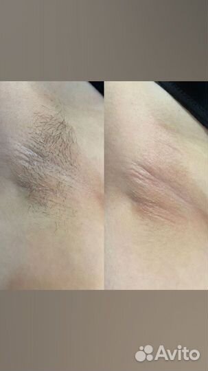 Шугаринг депиляция