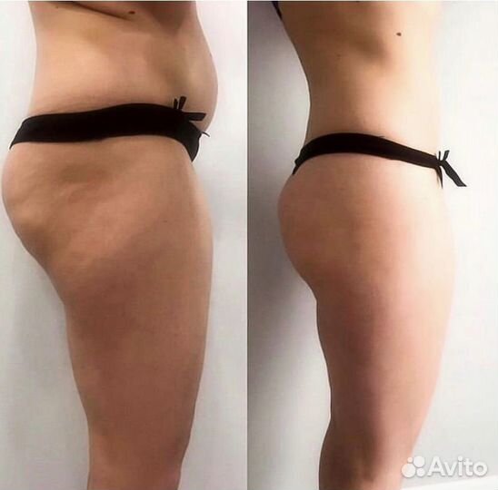 Антицеллюлитный массаж / LPG аппаратный массаж