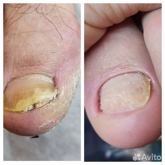 Медицинский педикюр. Подолог