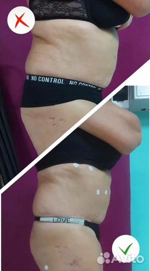 Бионити, коррекция фигуры, похудение, кетгут