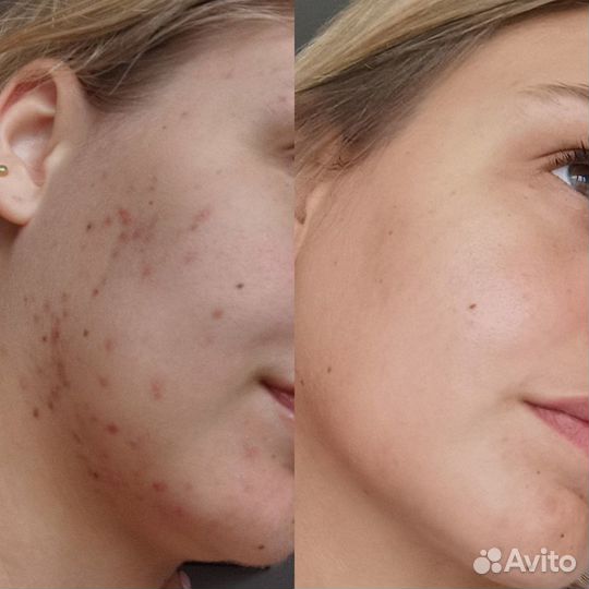 Карбокситерапия