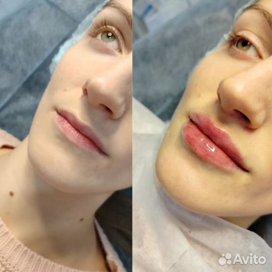 Косметолог:Увеличение губ,ботокс,уходы,прокол ушей