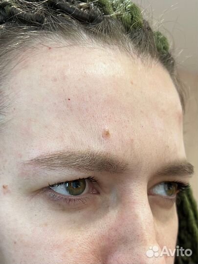 Ботулотоксин, ботокс (Релатокс)