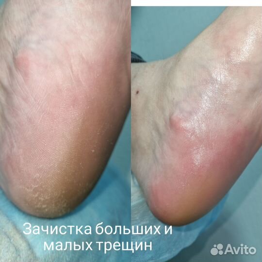 Подология педикюр